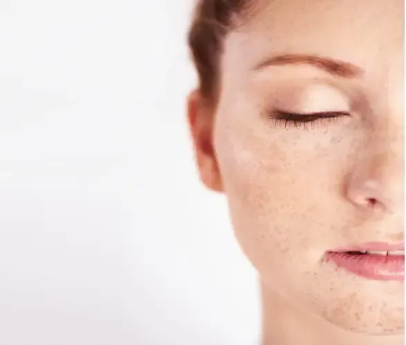 Melasma Treatment in Dwarka
