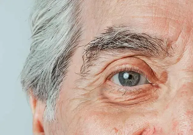 Anti Ageing Under Eye Bags Dwarka