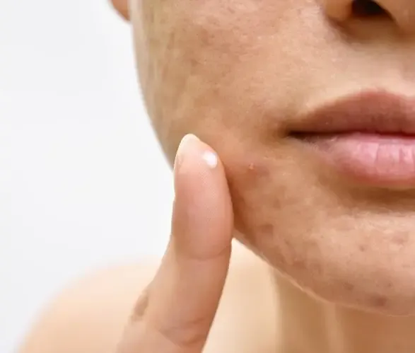 What is Acne Treatment in Dwarka