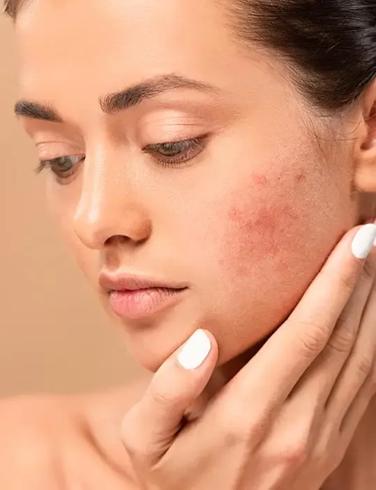 Acne Scars Treatment Doctor in Dwarka
