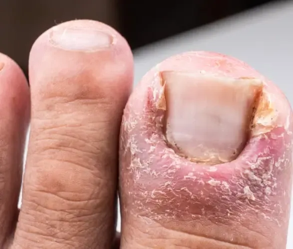 Fungal Infection Treatment in Dwarka