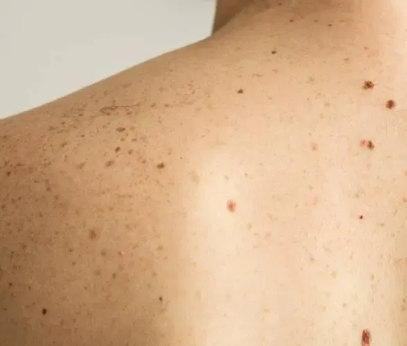 Warts & Skin Tags Removal in Dwarka