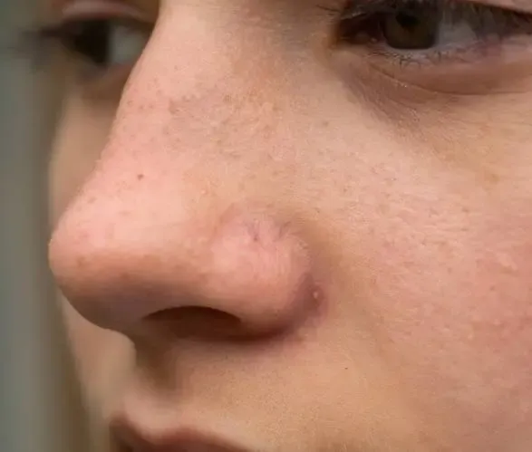 Rosacea Treatment in Dwarka