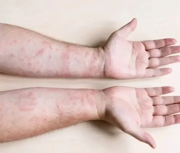 Psoriasis Treatment in Dwarka