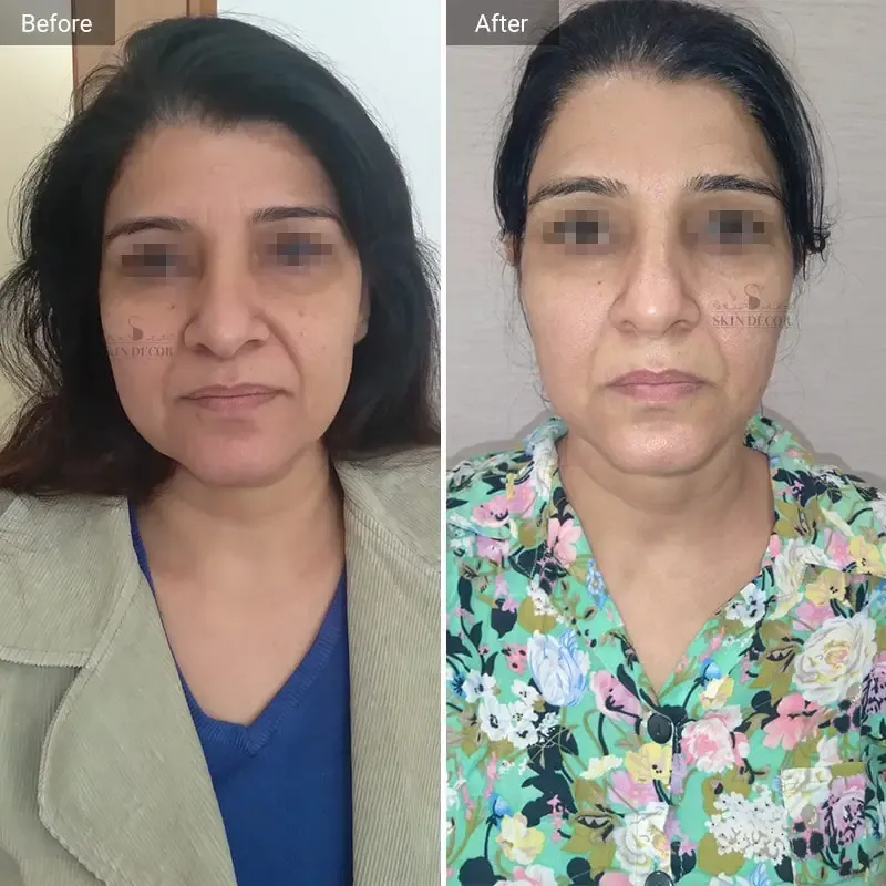 Face Rejuvenation Before After — Skin Decor Dermatology Clinic Dwarka