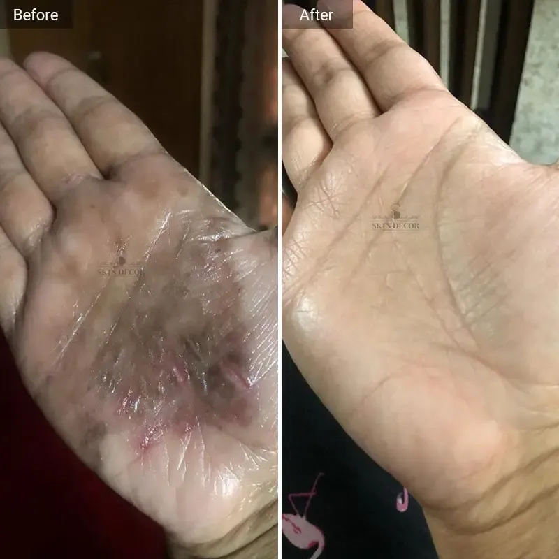 Eczema Skin Treatment Results — Skin Decor Clinic Dwarka Delhi