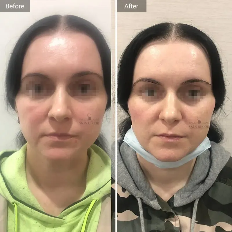 Cheek Lift Dermal Filler Results — Skin Decor Clinic Dwarka