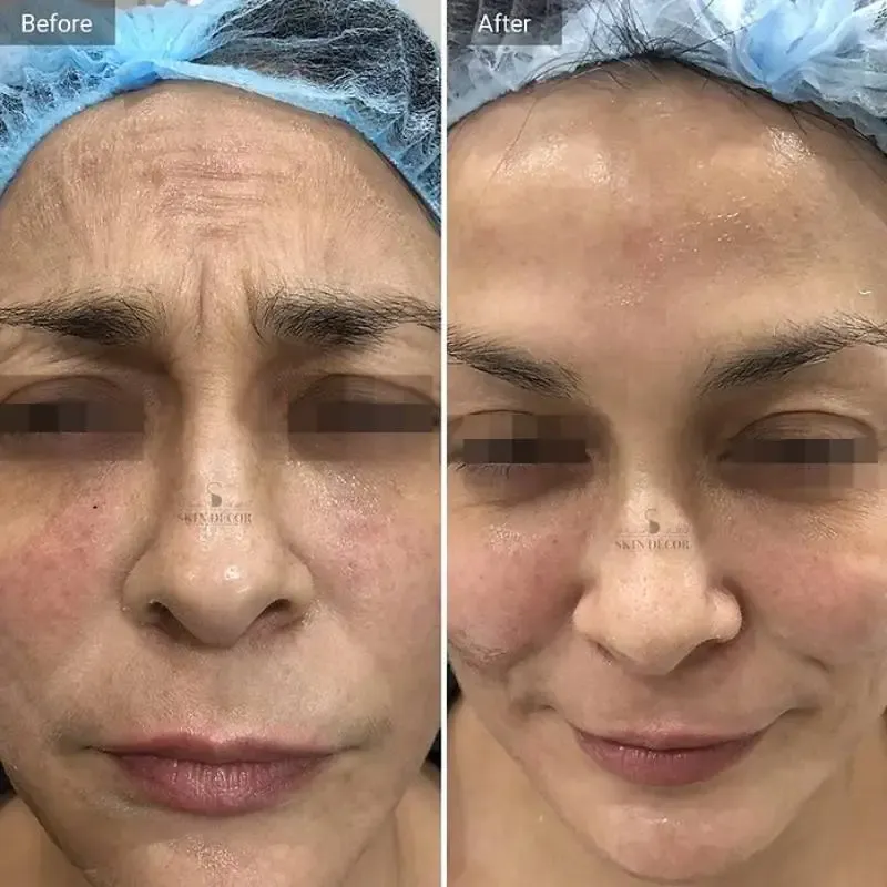 Anti-Wrinkle Botox Injection Results — Skin Decor Clinic Dwarka