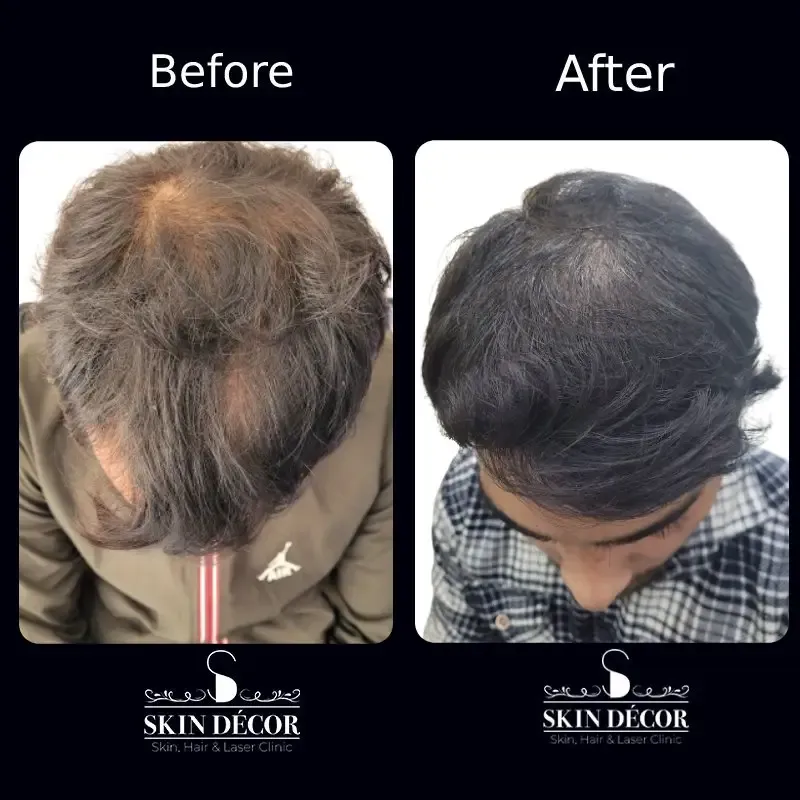 Hair Transplant FUE Results — Skin Decor Clinic Dwarka Delhi