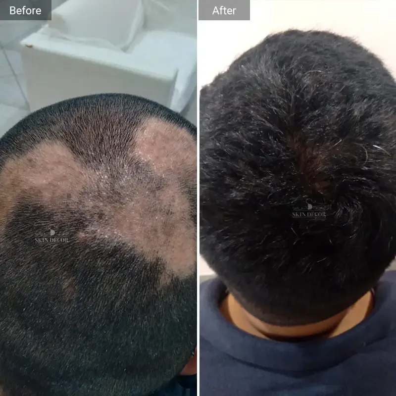 Alopecia (Hair Loss) Result #1