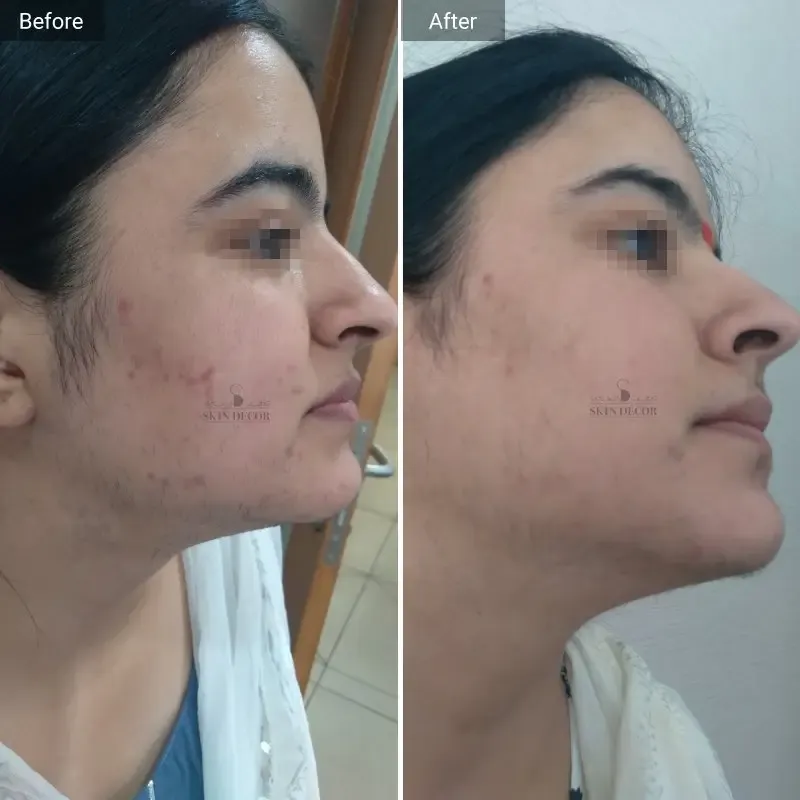 Laser Hair Removal Result #6
