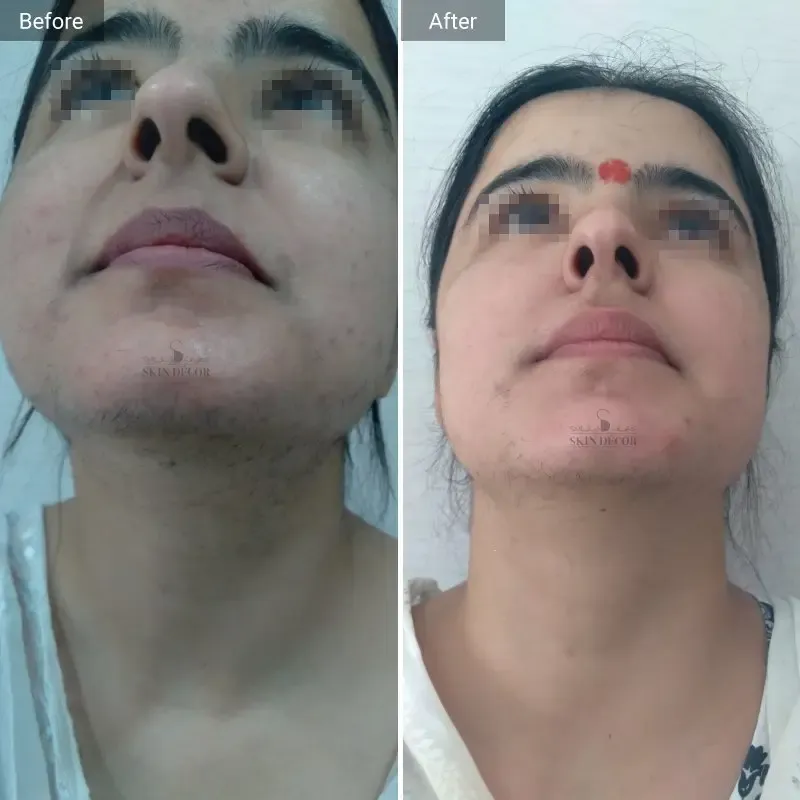 Laser Hair Removal Result #4