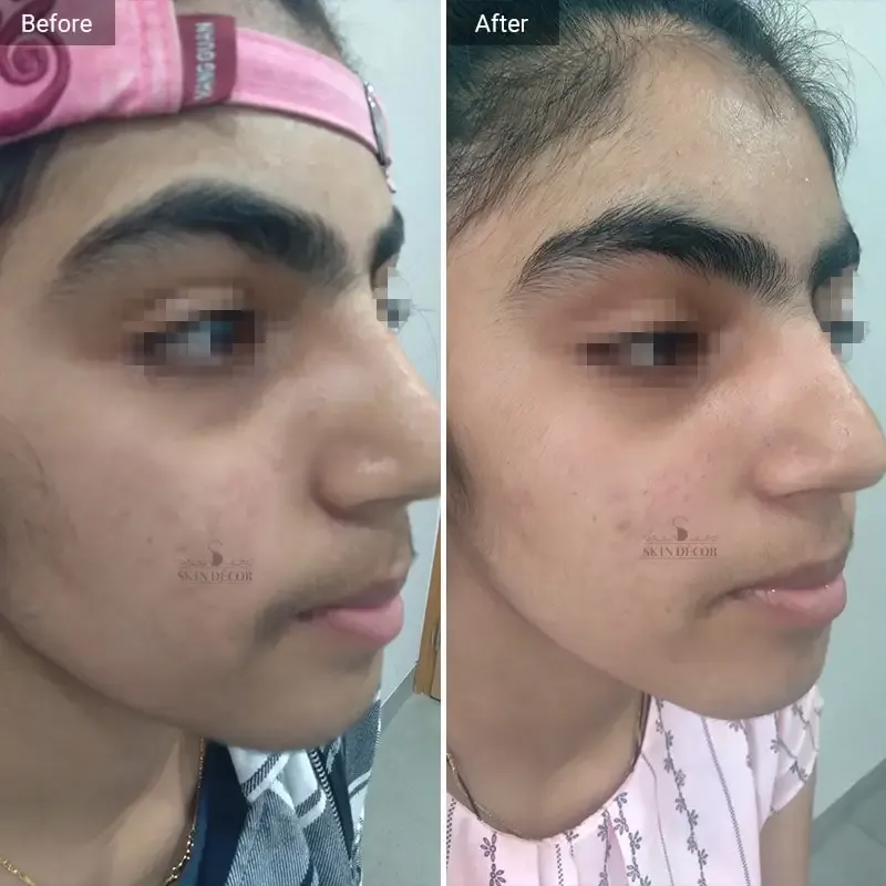 Laser Hair Removal Result #3