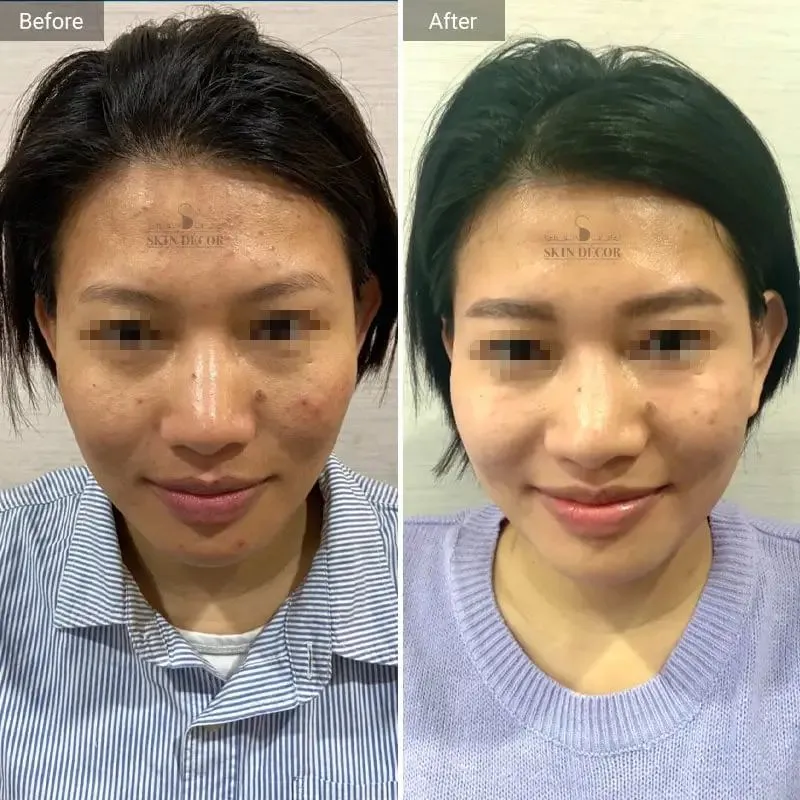Skin Decor Clinical Transformation Result