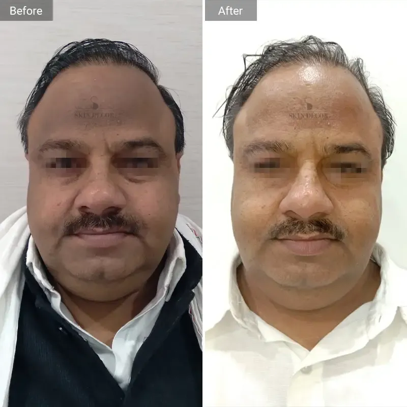 Skin Decor Clinical Transformation Result