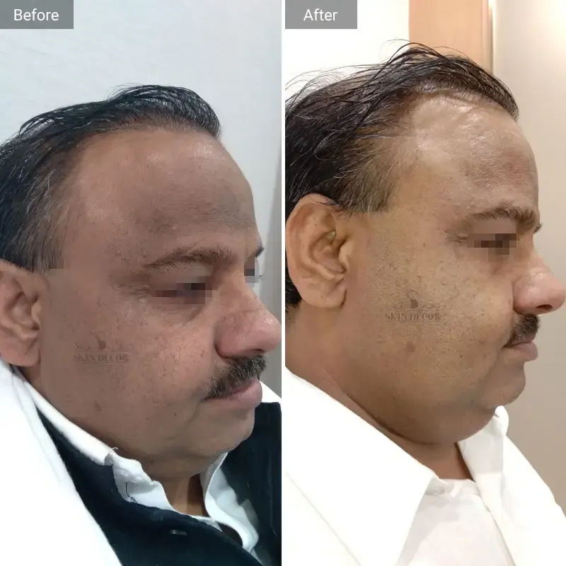 Skin Decor Clinical Transformation Result
