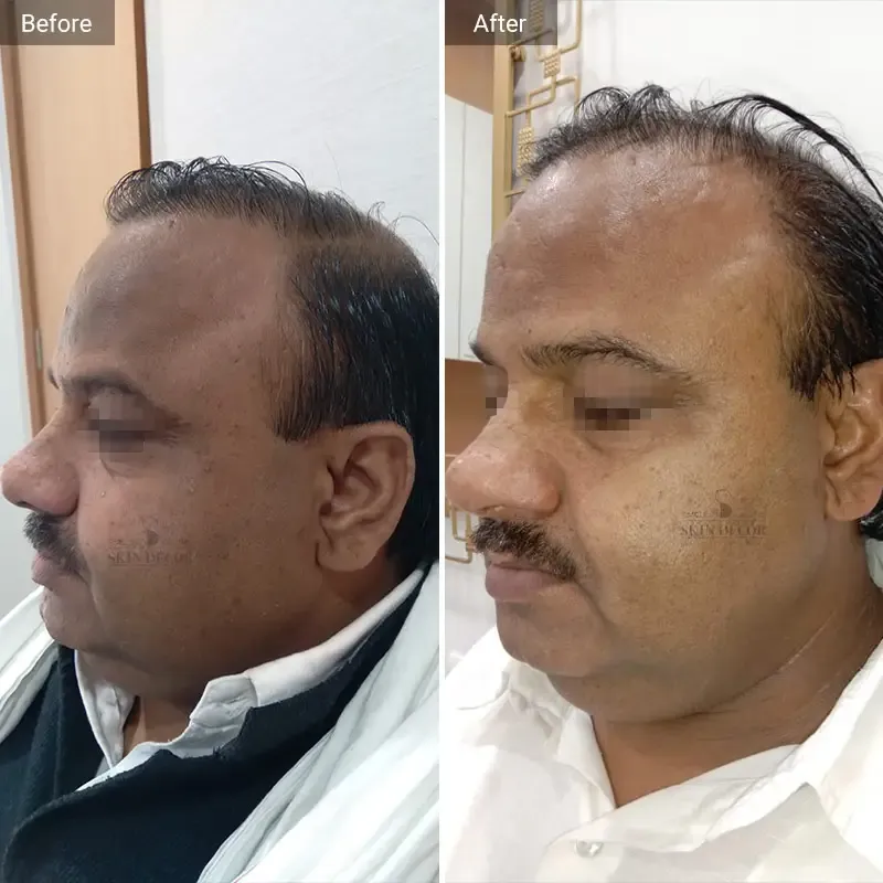 Face Rejuvenation Result #1