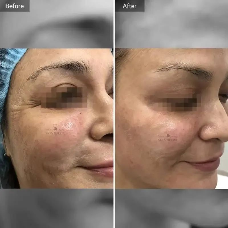 Anti-Wrinkle Injection Result #3