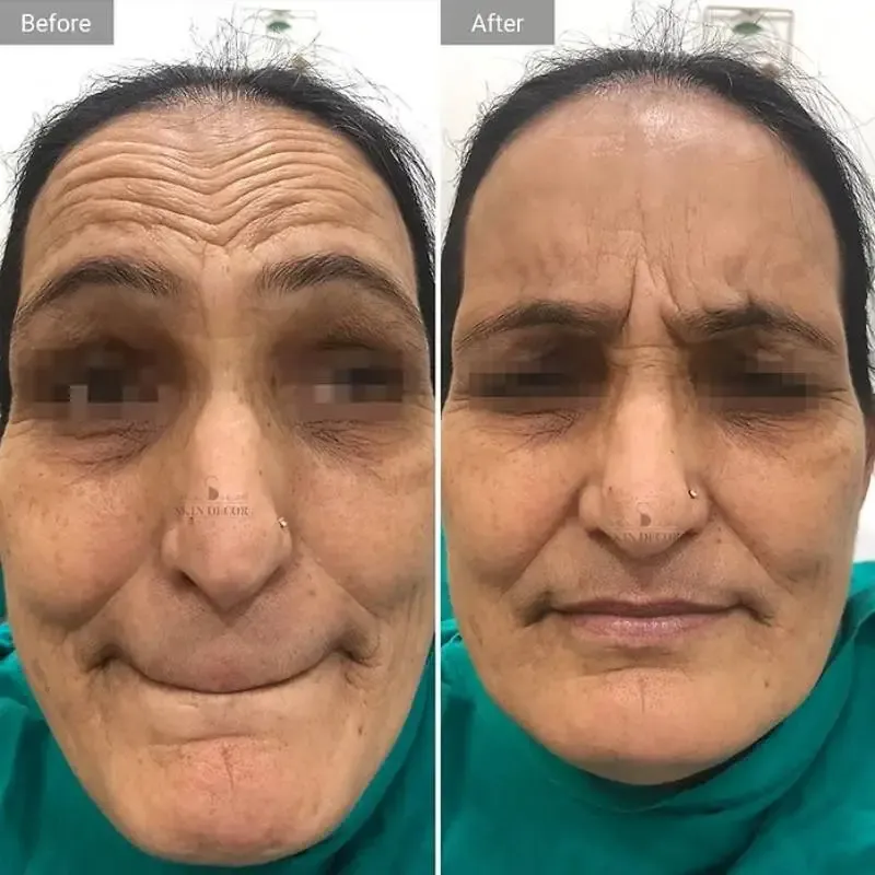 Anti-Wrinkle Injection Result #2