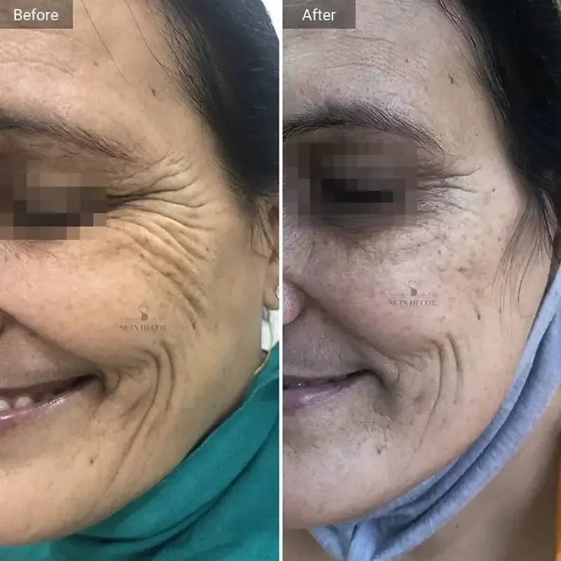 Anti-Wrinkle Injection Result #1