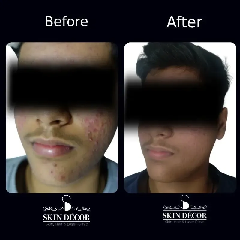 Laser Hair Removal Result #8
