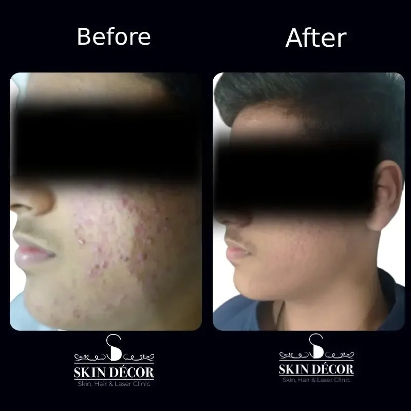 Laser Hair Removal Result #7
