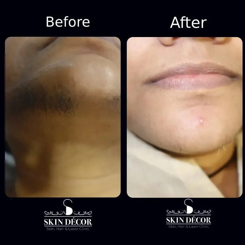 Laser Hair Removal Result #1