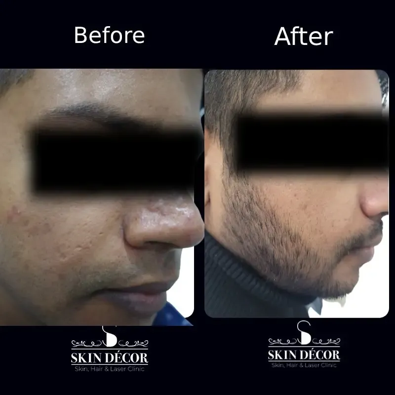Acne Scar Treatment Result #1