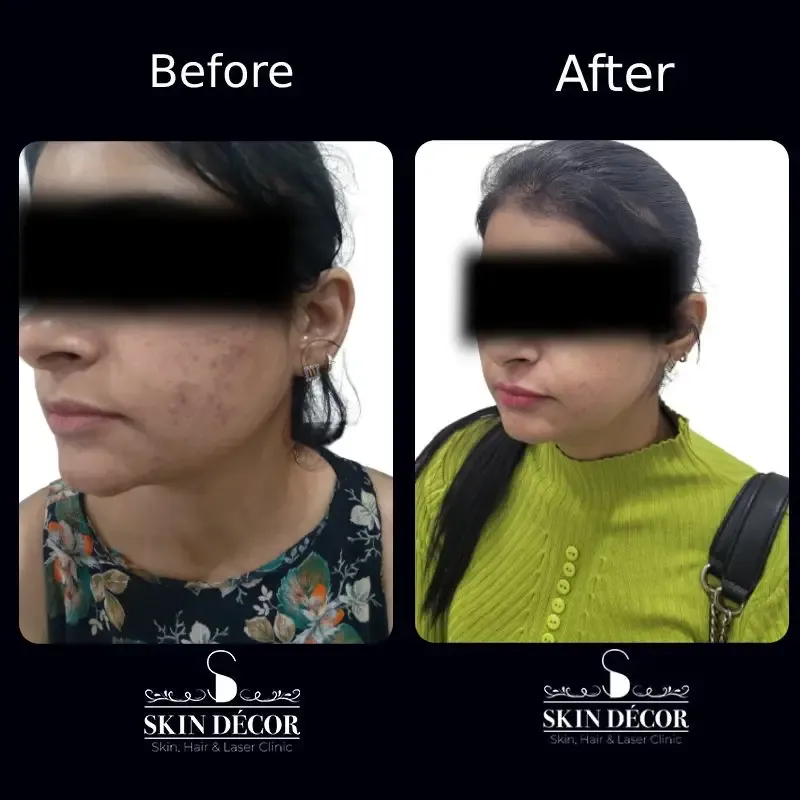Skin Decor Clinical Transformation Result