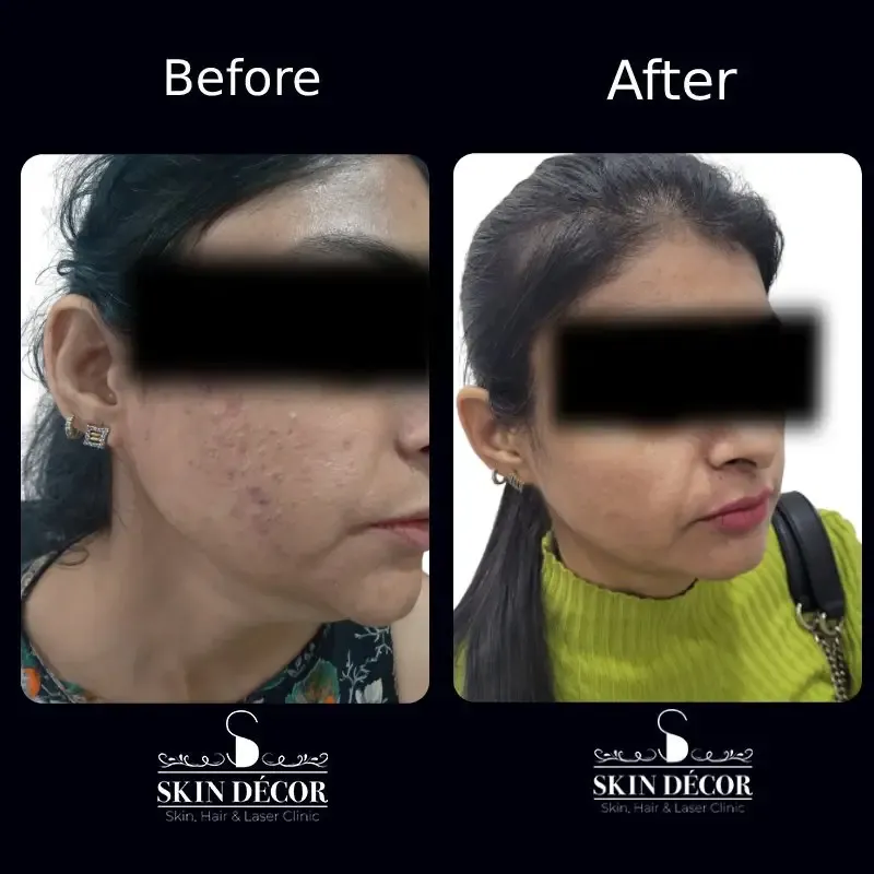 Skin Decor Clinical Transformation Result