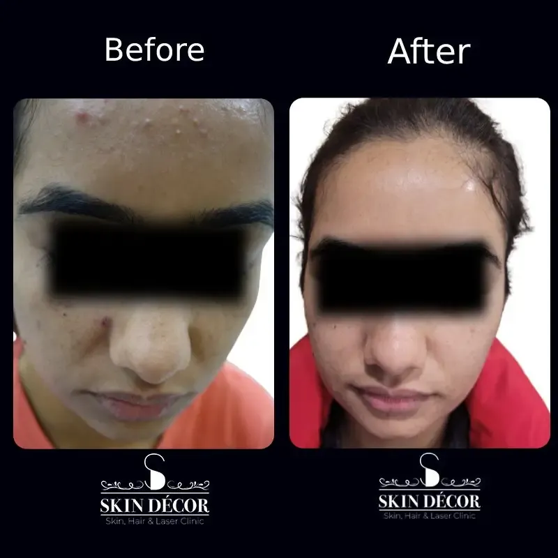 Acne Scar Treatment Result #10