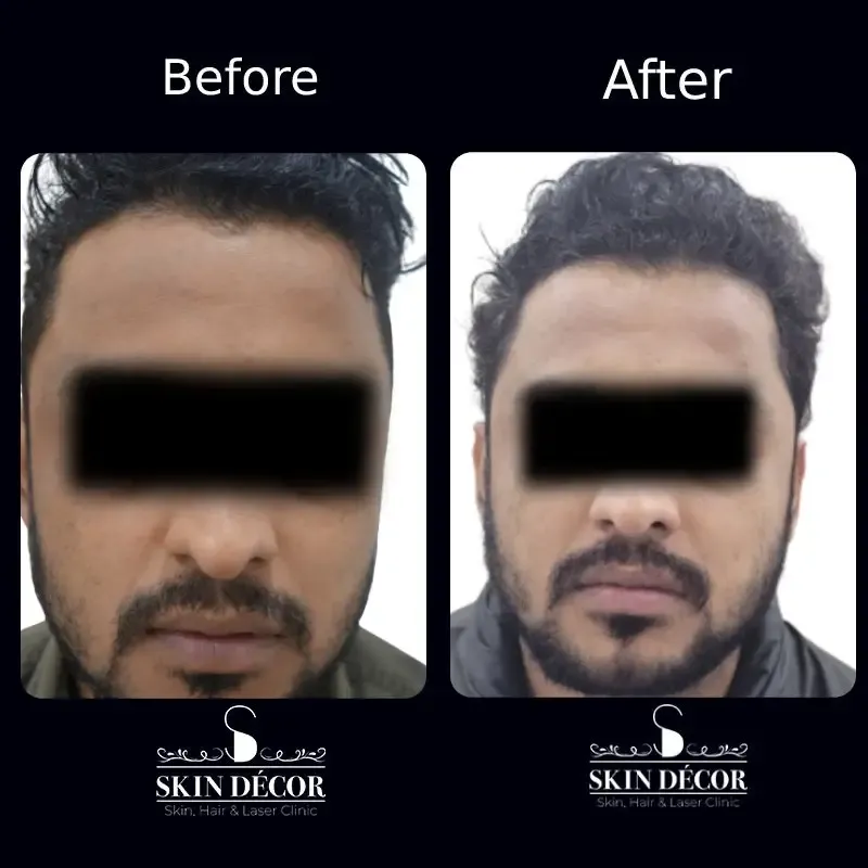 Skin Decor Clinical Transformation Result