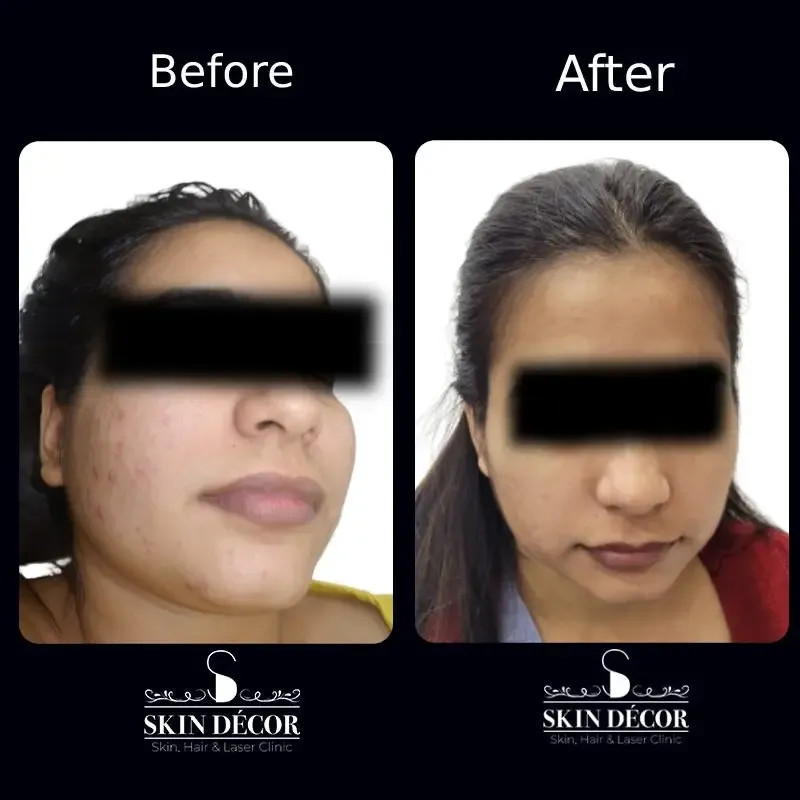 Skin Decor Clinical Transformation Result