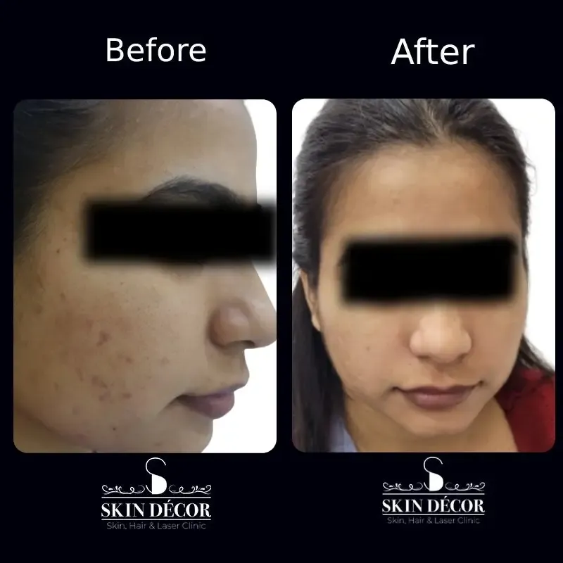 Acne Scar Treatment Result #7