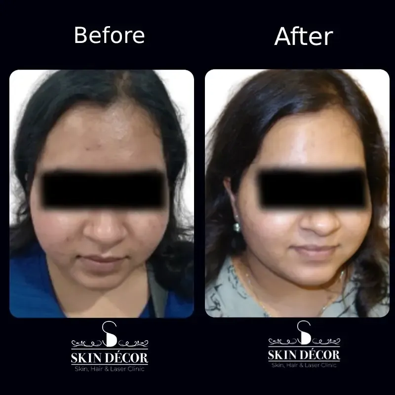 Acne Scar Treatment Result #6