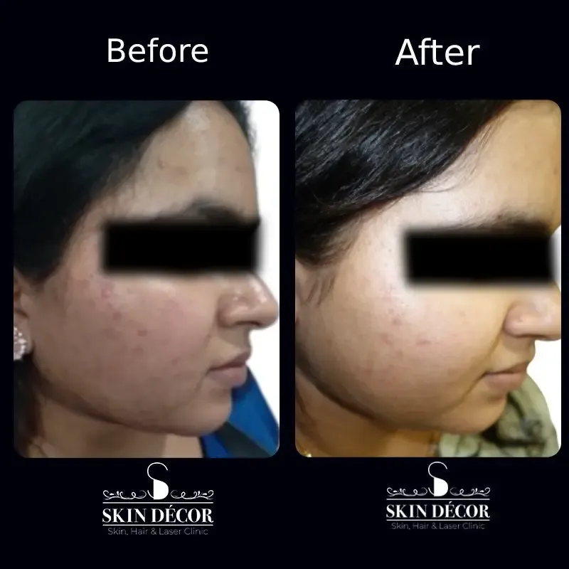 Acne Scar Treatment Result #5