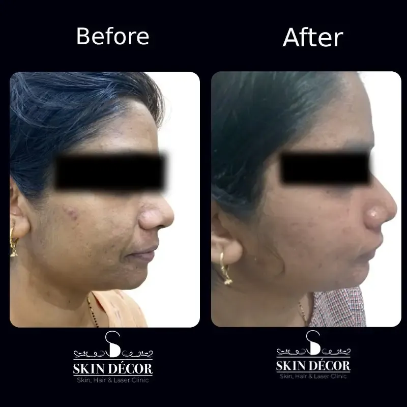 Acne Scar Treatment Result #4