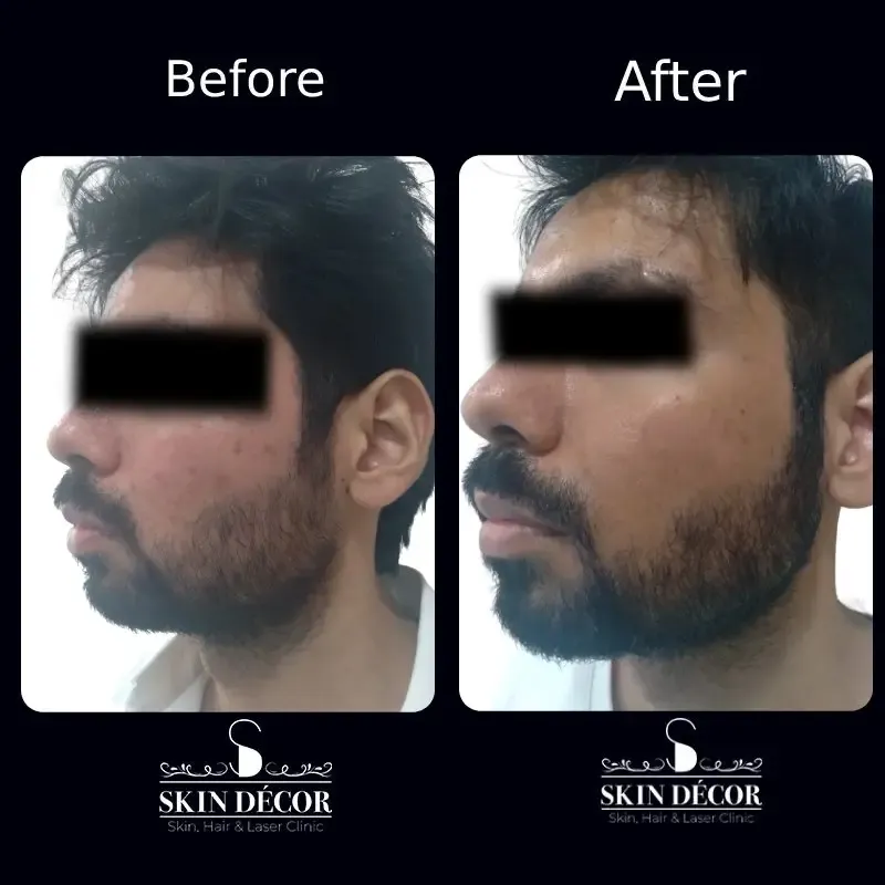 Acne Scar Treatment Result #3