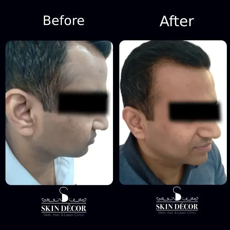 Acne Scar Treatment Result #2