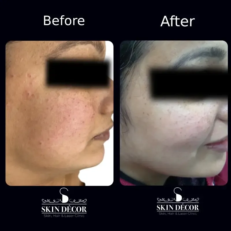 Melasma & Pigmentation Result #3