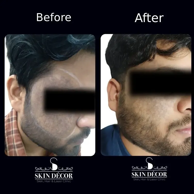 Melasma & Pigmentation Result #2
