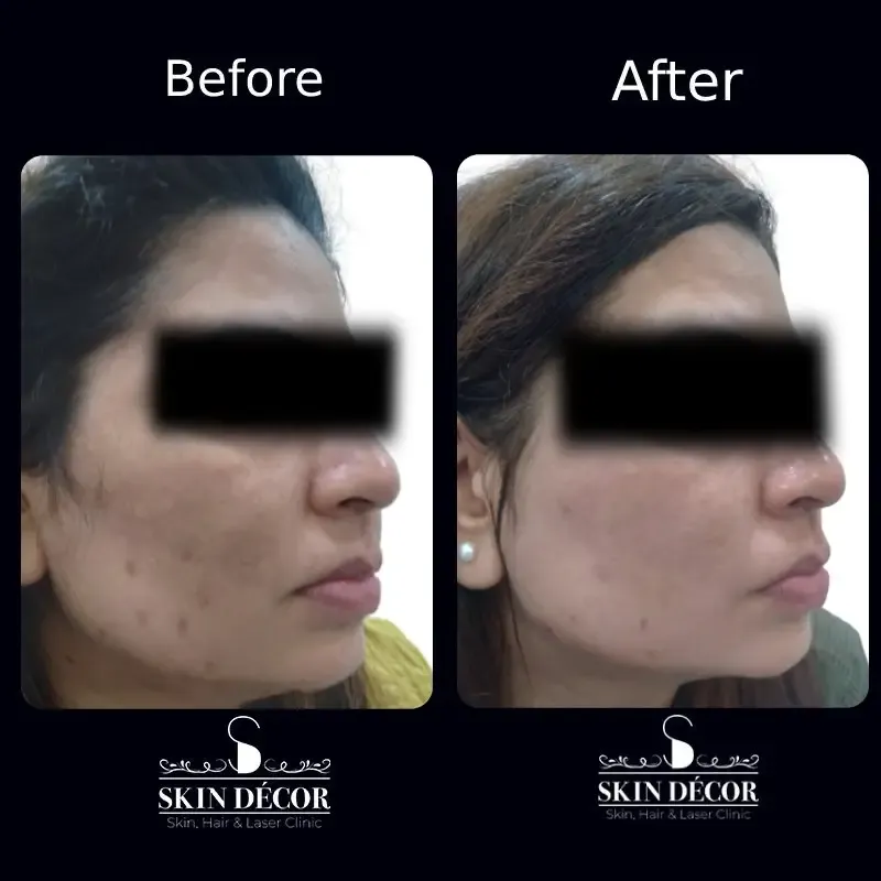 Melasma & Pigmentation Result #1
