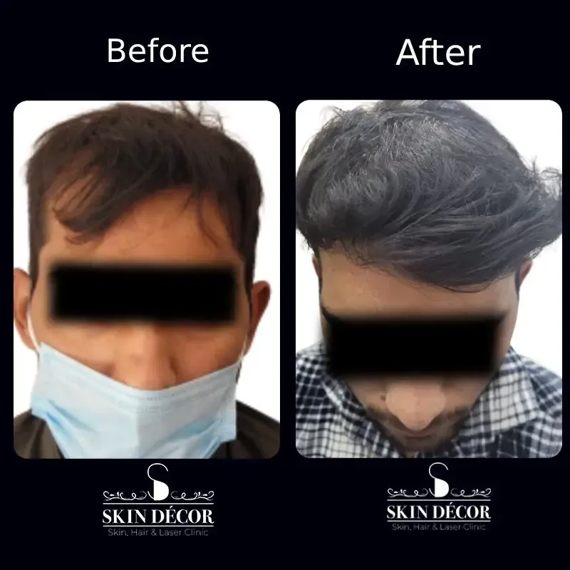 Skin Decor Clinical Transformation Result