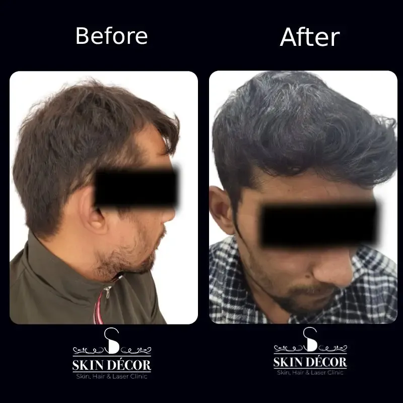 Hair Transplant Result #2