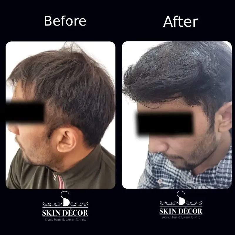 Hair Transplant Result #1