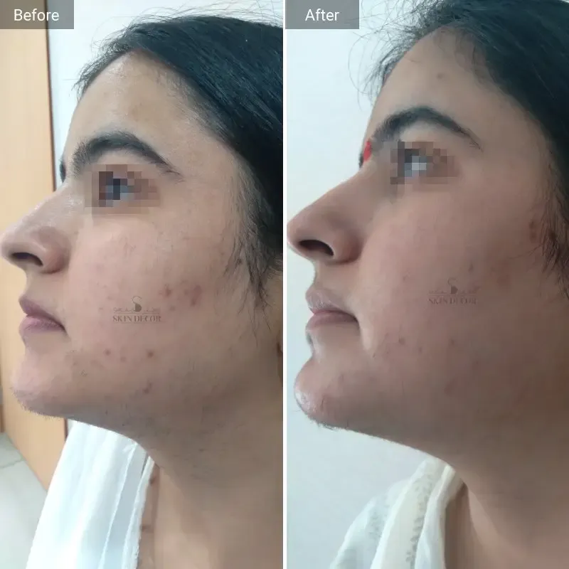 Laser Hair Removal Result #5
